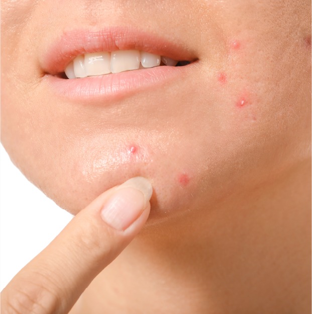 Acne-treatment.jpeg