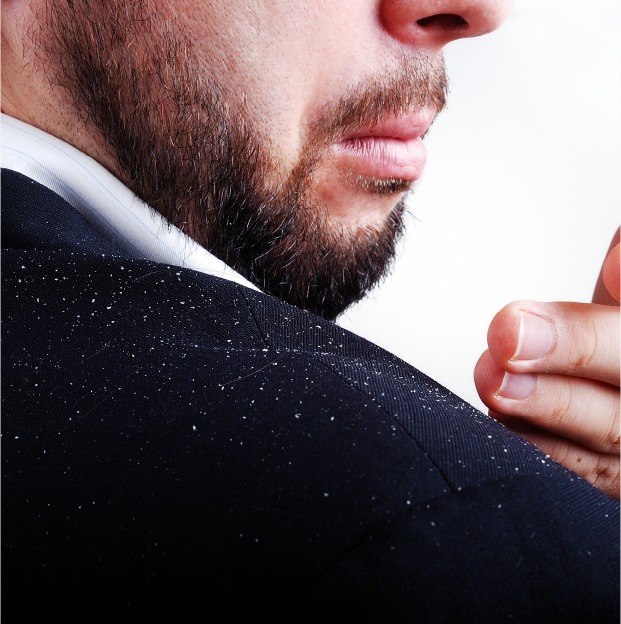 Dandruff-treatment.jpeg